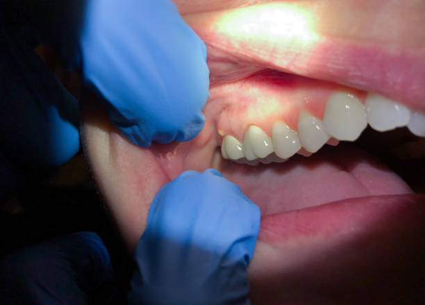 Best Emergency Dental Care for Broken or Chipped Teeth in Stony Prairie, OH